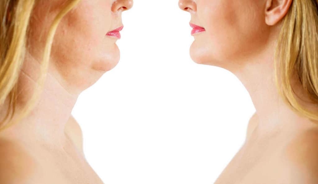 Double Chin treatment Huntingdon before and after results
