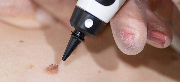 After Skin Tag Removal Huntingdon