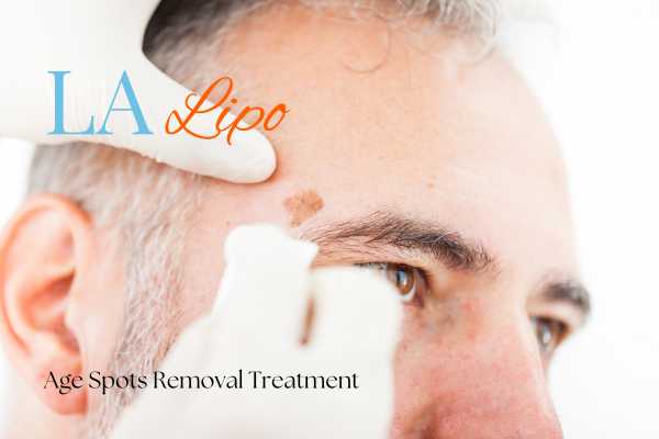 What Are the Most Effective Treatments for Age Spots Huntingdon?