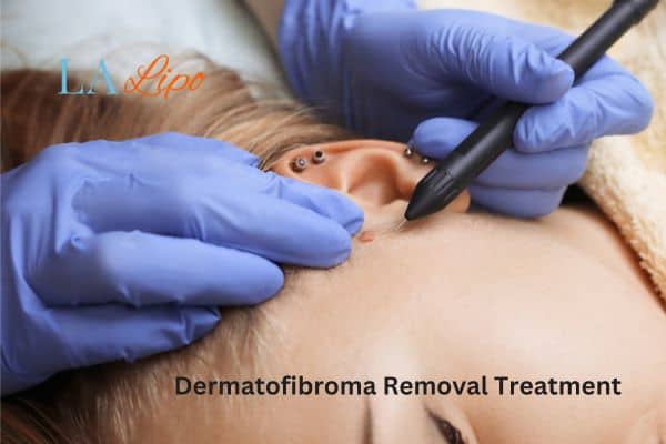 Dermatofibroma Removal Treatment Huntingdon