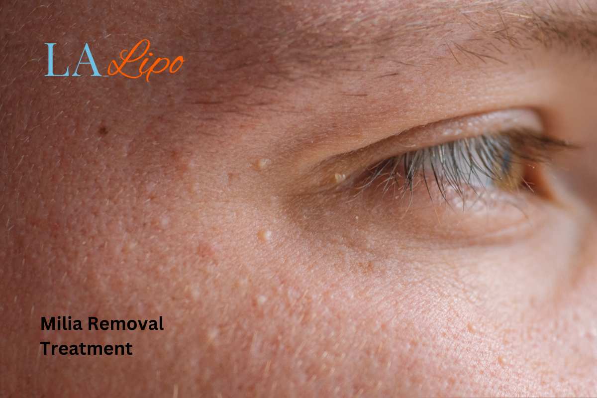 Cryopen Milia Removal: Is It the Easiest and Safest Option Huntingdon?