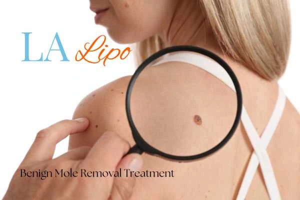 Woman having her inspection of blemish before mole removal Huntingdon