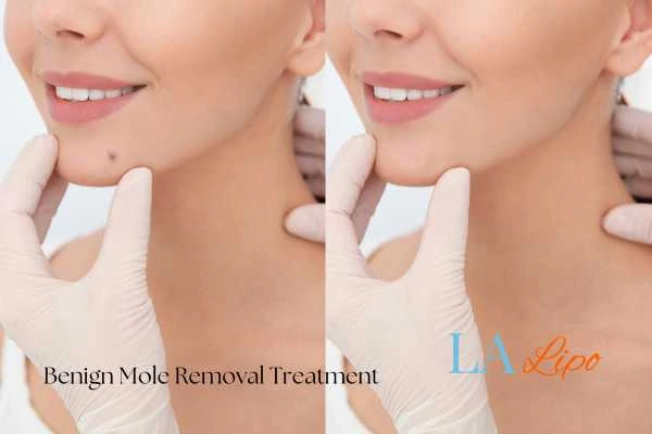 Before and after mole removal Huntingdon treatment