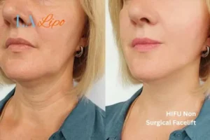 hi-fu for wrinkles Huntingdon before and after results