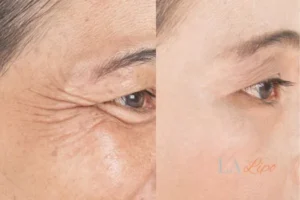 Before and after results of woman - HI-fu wrinkles reduction treatment Huntingdon