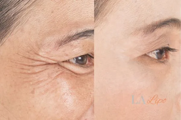 Before and after results of woman - HI-fu wrinkles reduction treatment Huntingdon