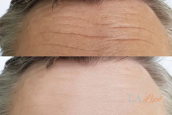 results of HIFU Huntingdon on mans forehead to help reduce lines and wrinkles