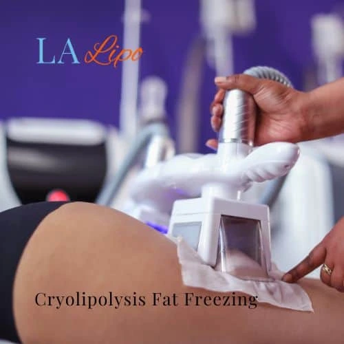 fat freezing - Cryolipolysis Huntingdon