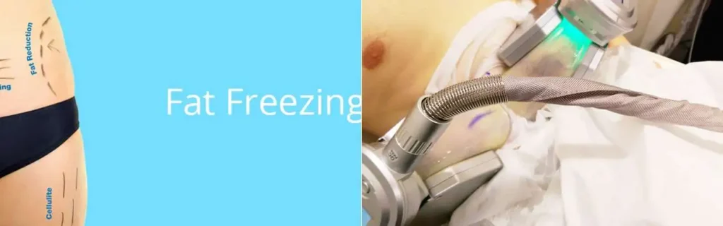 Fat freezing Huntingdon on multiple areas of the body