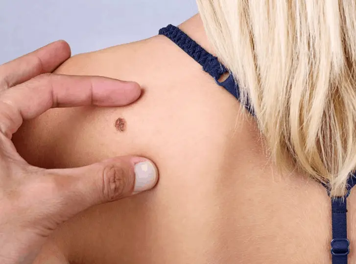 woman having mole removal Huntingdon consultation before treatment.