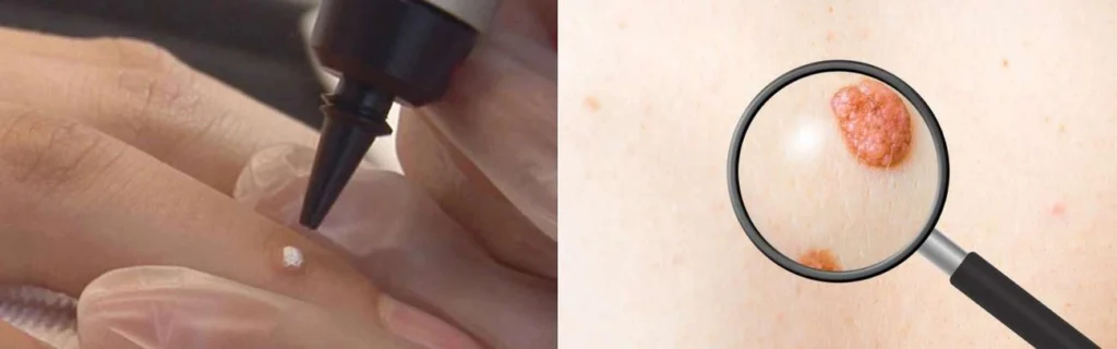 Person getting moles removed with cryopen Huntingdon