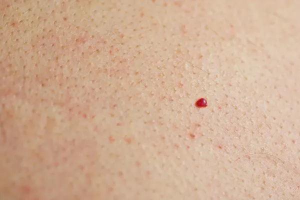 close up of a cherry angioma Huntingdon