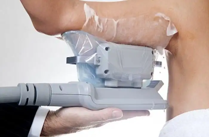 Picture of fat freezing Huntingdon on the upper arms.