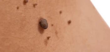 image of a skin tag Huntingdon