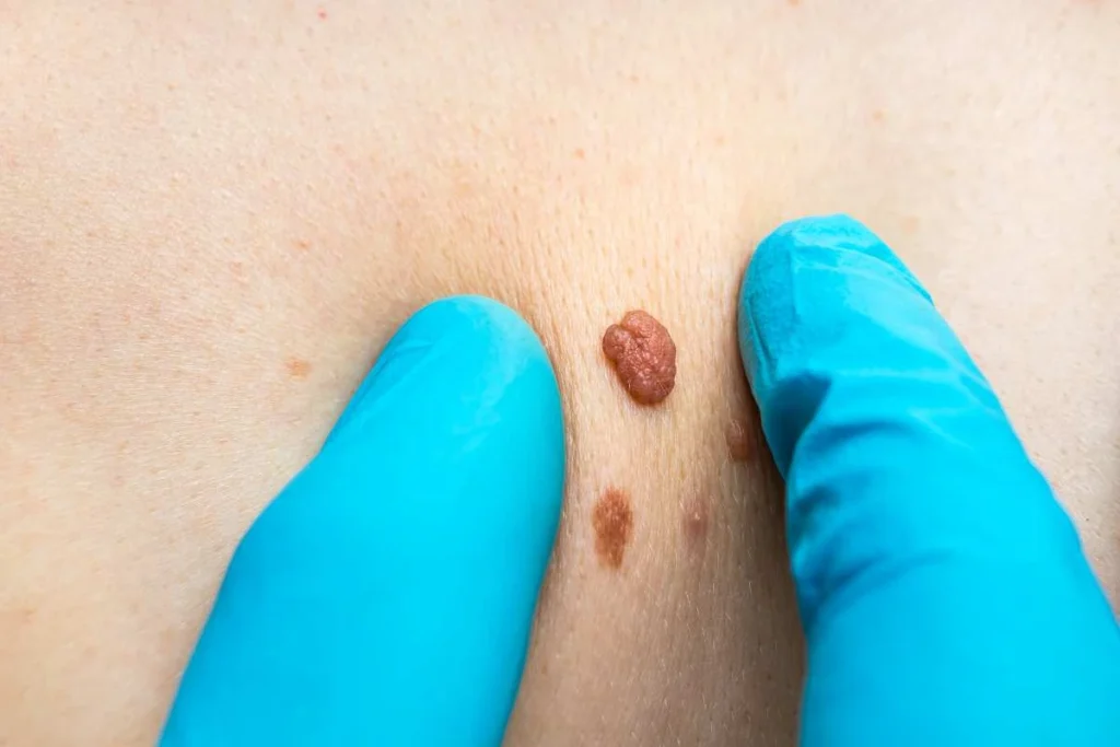 Consultant examining a skin tag Huntingdon