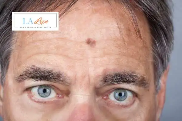 Solar Lentigo Removal Huntingdon image of man with mark on his forehead