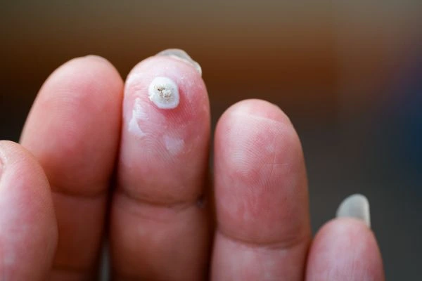 wart on person finger - cryotherapy to treat from LA LIPO Huntingdon