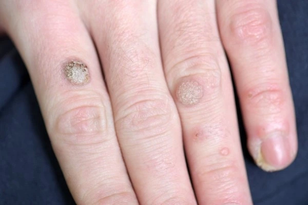 photo of warts on person hand - see wart removal Huntingdon from LA LIPO