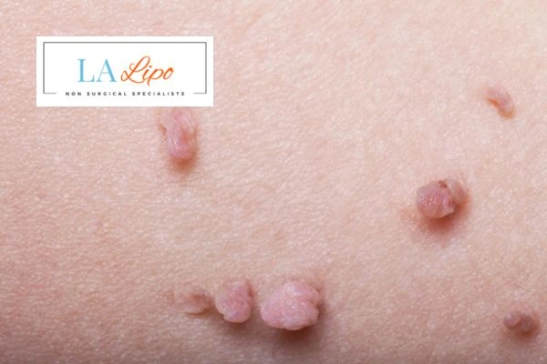 Does cryopen skin tag removal Huntingdon hurt? Find out now call our team today!