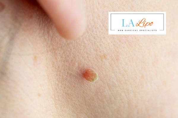 Book skin tag removal Huntingdon today speak to our team now!