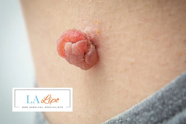 Interested in skin tag removal Huntingdon? Concerned about the pain? Find out more today!