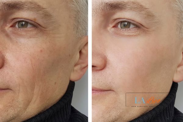 See the amazing results of Morpheus8 Treatment Huntingdon!