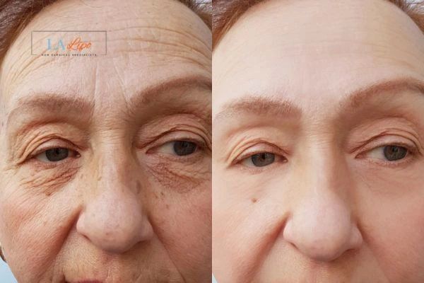 The powerful benefits of Morpheus8 Treatment Huntingdon - Call Our team today!
