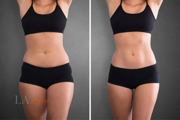 before and after results of non-surgical treatment to help a woman's body image and mental health Huntingdon