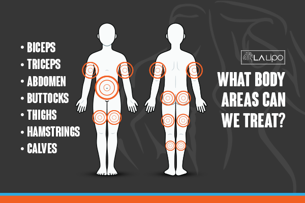 Diagram to show areas you can have LA-EMS Body Sculpting Treatment Huntingdon