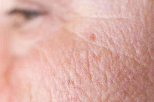 close up picture of a woman's face showing an age spot Huntingdon