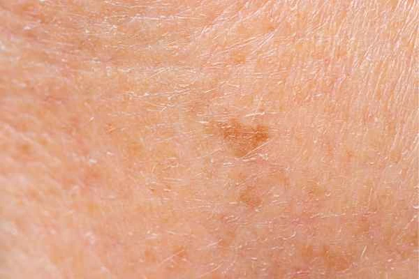 close up picture of age spots Huntingdon