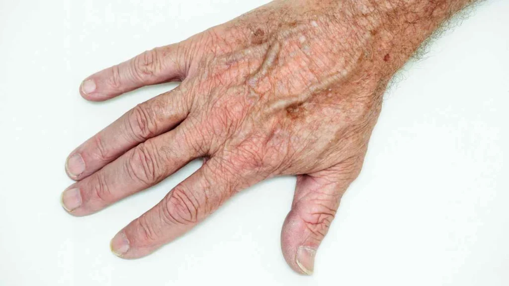 Male hand showing age spot Huntingdon
