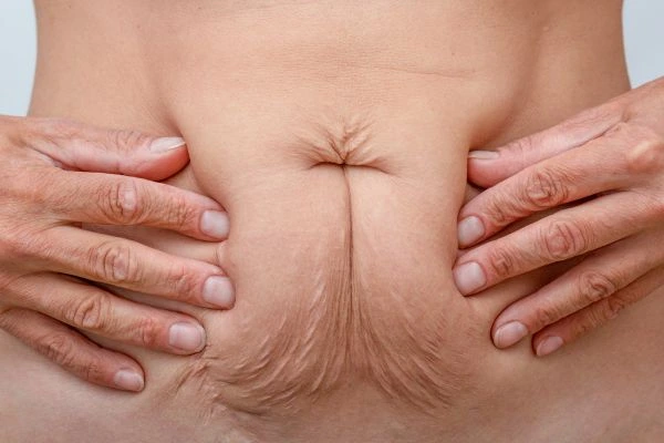 Image of a woman's stomach with loose skin - example of skin tightening Huntingdon options