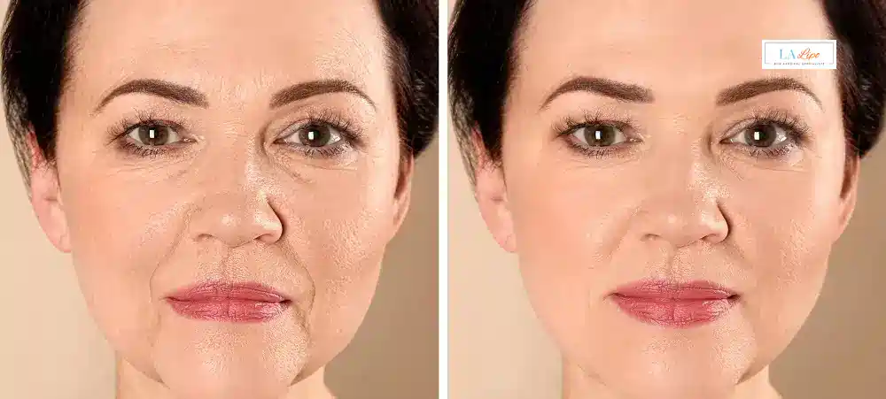 How Long Does It Take to See Results and How Long Do They Last Huntingdon?