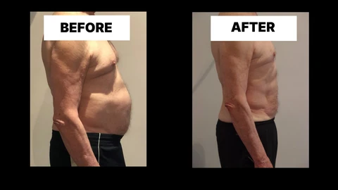 What Symptoms Can Diastasis Recti Cause in Men? Weak Core, Back Pain and Poor Posture Huntingdon